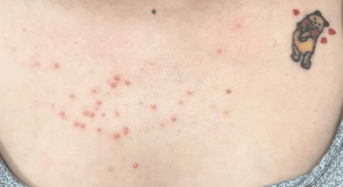 IPL redness treatment before and after - before