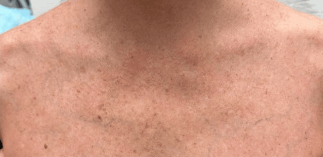 IPL skin renewal before and after - after