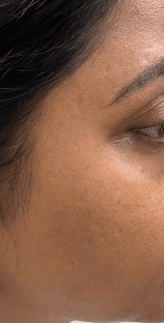 Laser skin resurfacing before and after - after