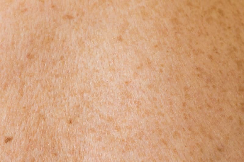 Laser Scar Removal